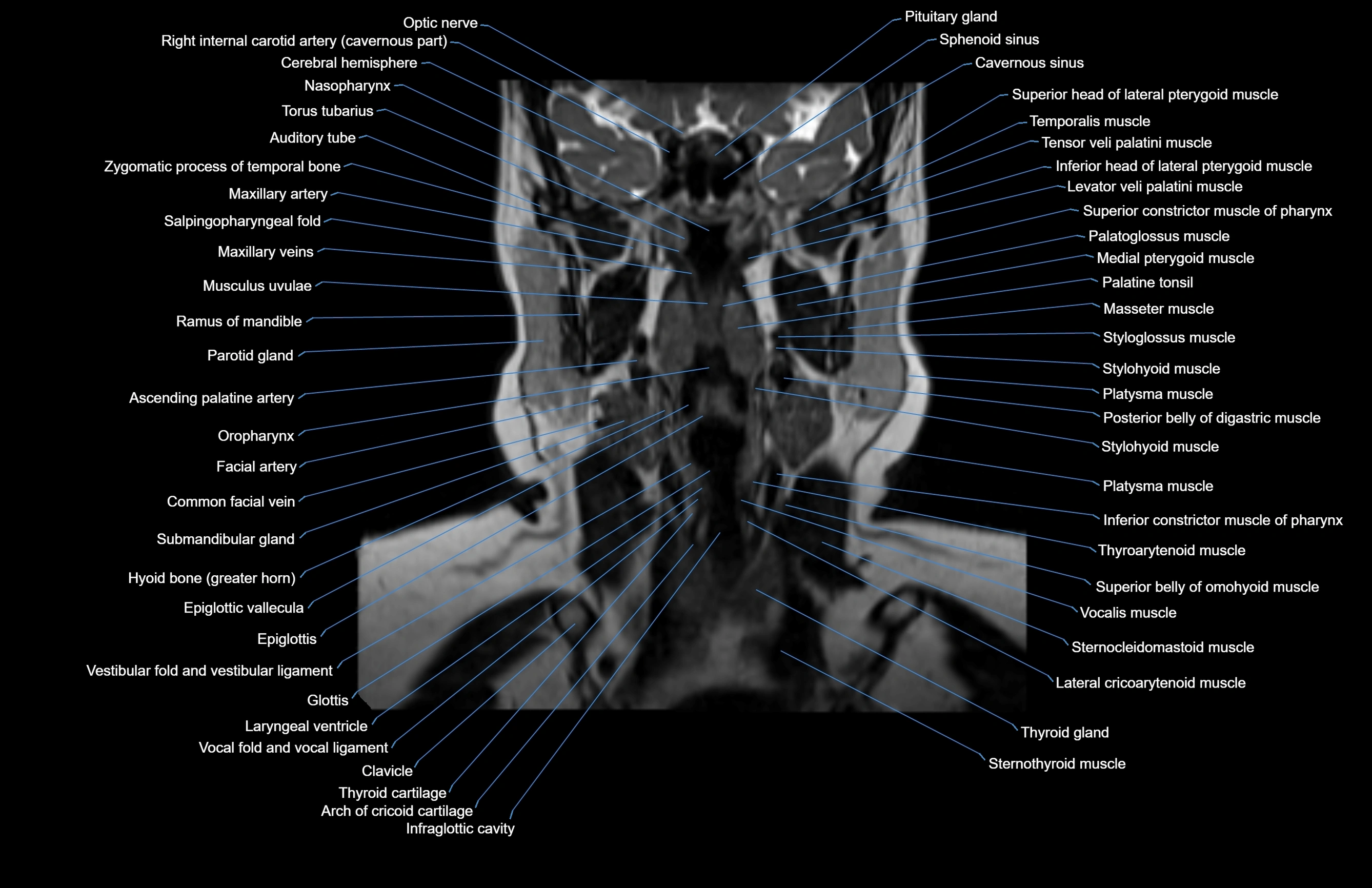 Neck coronal cross sectional MRI anatomy 3T MRI  image-img-00001-00044.webp
